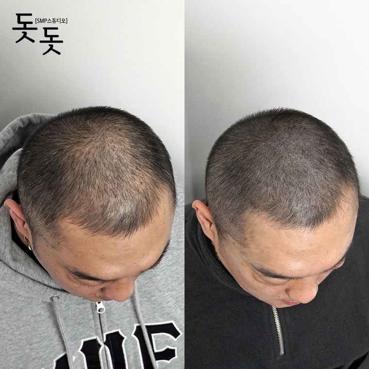삭발 두피문신 전후 사례 11