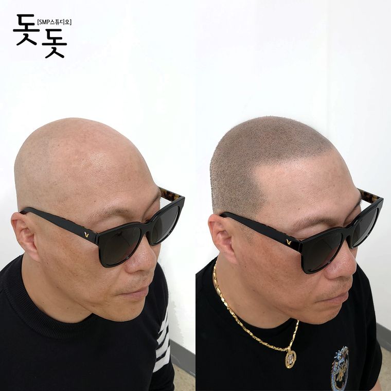 삭발 두피문신 전후 사례 13