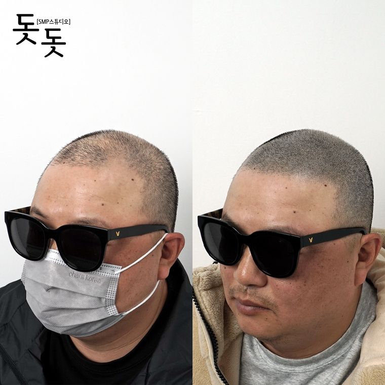 삭발 두피문신 전후 사례 15