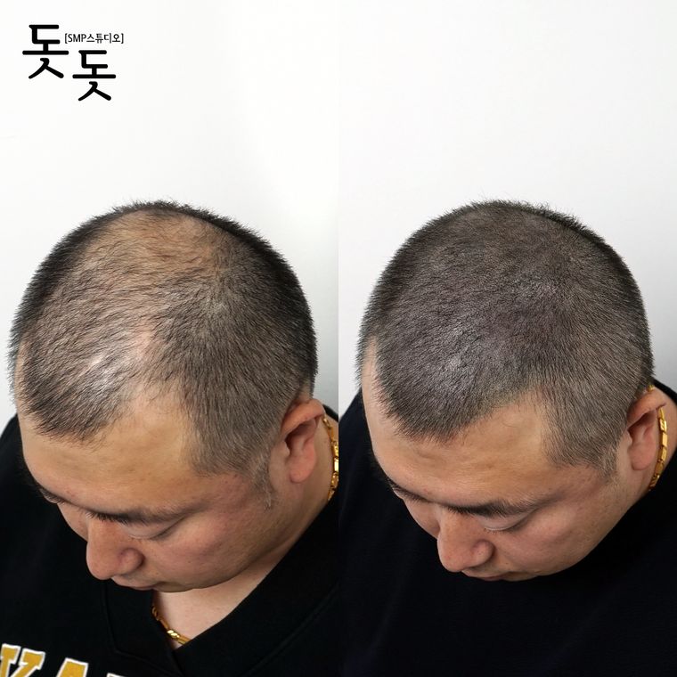 삭발 두피문신 전후 사례 16