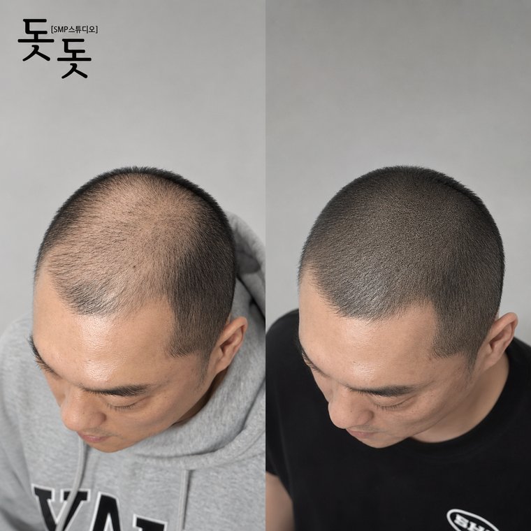 두피문신보강 삭발 디자인 시술 전후 사례