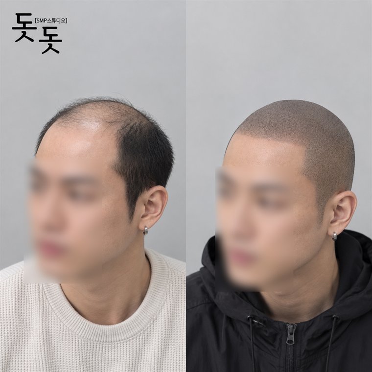 삭발 두피문신 전후 사례 26