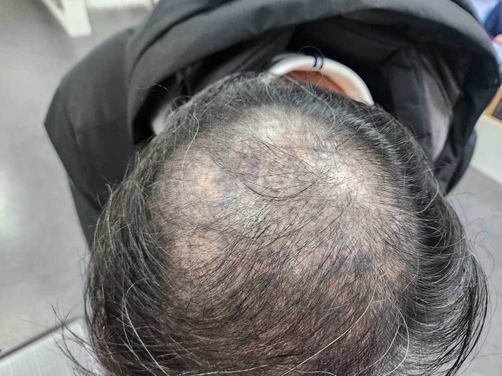 두피문신부작용 부작용 사례 · 흰머리 사이 진한 얼룩